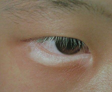 白癜风的危害.jpg