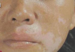 脸上出现白癜风是怎么回事