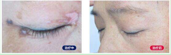 白癜风治疗.jpg