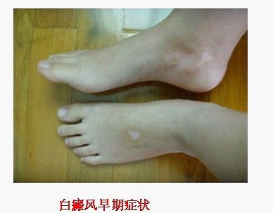 白癜风治疗.jpg