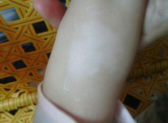 儿童白癜风发病症状是什么
