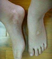 白癜风早期症状.jpg